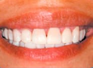 Cypress Springs Family Dentistry - teeth whitening after