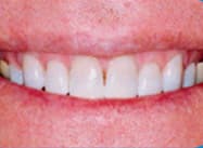 Cypress Springs Family Dentistry - teeth whitening after