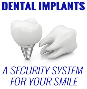 Dental Implants – A Security System for Your Smile